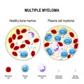 Multiple myeloma. plasma cell myeloma Royalty Free Stock Photo