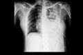 multiple rib fractures with hemothorax