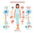 Multiple sclerosis anatomical vector illustration diagram, medical scheme.