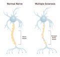 Multiple sclerosis. Autoimmune disease affecting the central nervous system. Royalty Free Stock Photo