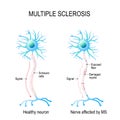 Multiple sclerosis. autoimmune disease. Royalty Free Stock Photo