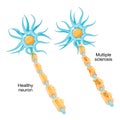 Multiple sclerosis. autoimmune disease Royalty Free Stock Photo