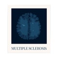 MRI scan of the brain affected by multiple sclerosis