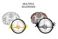 Multiple sclerosis of the brain