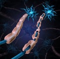 Multiple Sclerosis Damaged Myelin Royalty Free Stock Photo