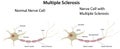 Multiple Sclerosis Diagram Royalty Free Stock Photo