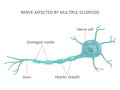 Multiple Sclerosis Failure Myelin Cells Autoimmune Disease Royalty Free Stock Photo