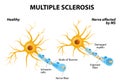 Multiple Sclerosis Royalty Free Stock Photo