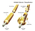 Multiple sclerosis nerve damage