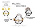 Multiple sclerosis. Neurology Royalty Free Stock Photo