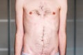 Muscular dystrophy of a man with a protrusion of the abdomen