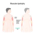 Muscular dystrophy Royalty Free Stock Photo