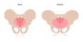 Muscular pelvis concept