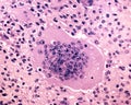 Mutinucleated giant cell