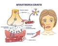 Myasthenia gravis as autoimmune, neuromuscular disease outline diagram Royalty Free Stock Photo