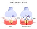 Myasthenia gravis. Autoimmune disease. neuron and muscle Royalty Free Stock Photo