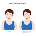 Myasthenia gravis. Girl with neuromuscular disease