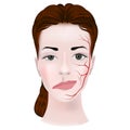 Myasthenia. Woman\'s twisted face.