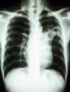Mycobacterium tuberculosis infection (Pulmonary Tuberculosis) Royalty Free Stock Photo