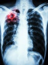 Mycobacterium tuberculosis infection (Pulmonary Tuberculosis) Royalty Free Stock Photo