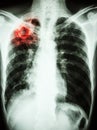 Mycobacterium tuberculosis infection (Pulmonary Tuberculosis) Royalty Free Stock Photo