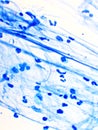 Mycobacterium tuberculosis positive in sputum smear