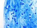 Mycobacterium tuberculosis positive in sputum smear