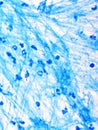 Mycobacterium tuberculosis positive in sputum smear Royalty Free Stock Photo