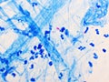 Mycobacterium tuberculosis positive in sputum smear