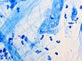 Mycobacterium tuberculosis positive in sputum smear