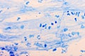Mycobacterium tuberculosis positive in sputum smear Royalty Free Stock Photo