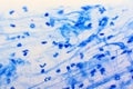 Mycobacterium tuberculosis positive in sputum smear Royalty Free Stock Photo