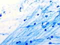 Mycobacterium tuberculosis positive in sputum smear