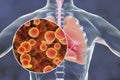 Mycoplasma pneumoniae bacteria in human lungs