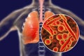 Mycoplasma pneumoniae bacteria in human lungs