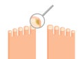 Mycosis on toenail