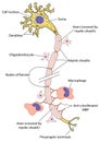 Myelinated nerve in multiple sclerosis