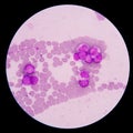 Myeloblasts showing in blood smear.