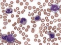 Myelodysplastic myeloproliferative neoplasm with neutrophilia. Royalty Free Stock Photo