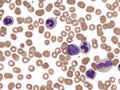 Myelodysplastic myeloproliferative neoplasm with neutrophilia. Royalty Free Stock Photo