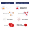 Multiple myeloma Royalty Free Stock Photo