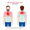 Myocardial Infarction areas. Heart attack. pain location