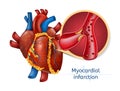 Myocardial infarction. 3d Realostic Heart Royalty Free Stock Photo