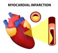 Myocardial infarction Royalty Free Stock Photo