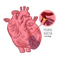 MYOCARDIAL INFARCTION SCHEME Heart Attack Medicine Education Royalty Free Stock Photo