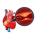 Myocardial infarction vector Royalty Free Stock Photo