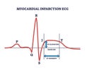 Myocardial infraction ECG with abnormal ST segment elevation outline diagram