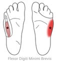 Flexor digiti minimi brevis, myofascial trigger point causing side foot pain