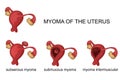 Myoma of the uterus