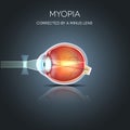Myopia corrected Royalty Free Stock Photo